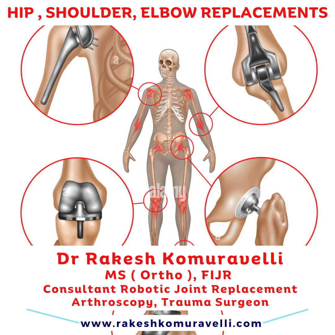 Hip , Shoulder, Elbow Replacements