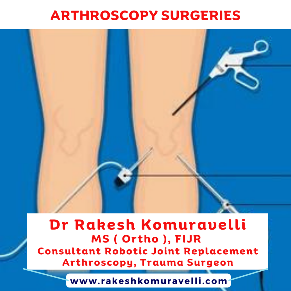 Arthroscopy Surgeries